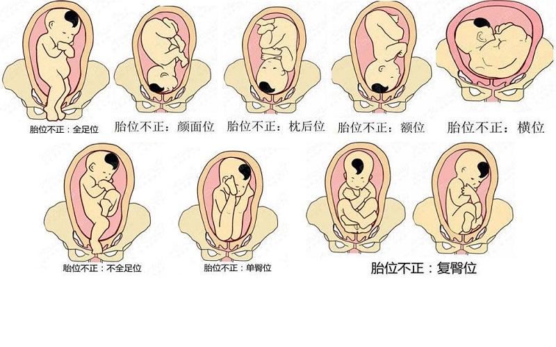 左枕前位胎儿图是正常胎位吗