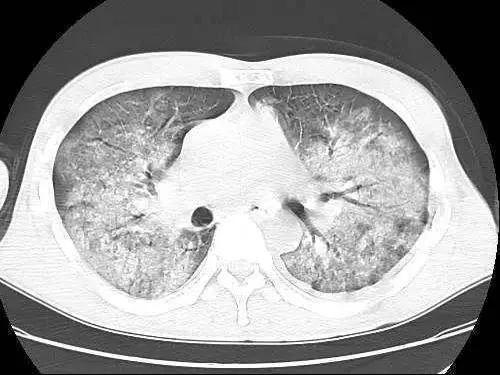肺部x光片有大面积白色阴影
