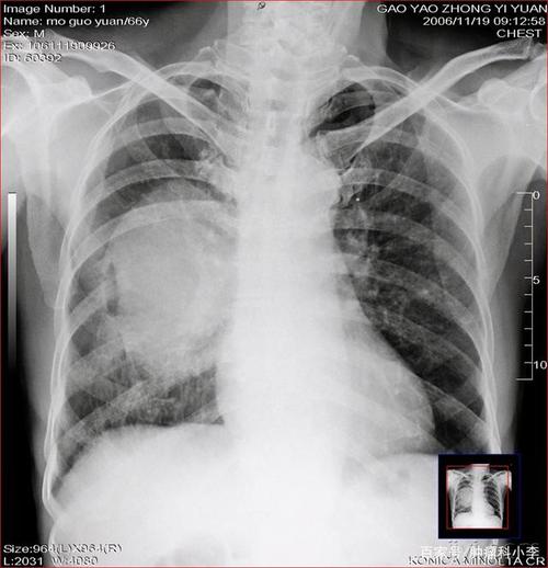 肺部x光片能看出肺癌吗